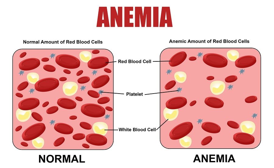 What is Iron deficiency anaemia with its causes and treatment?